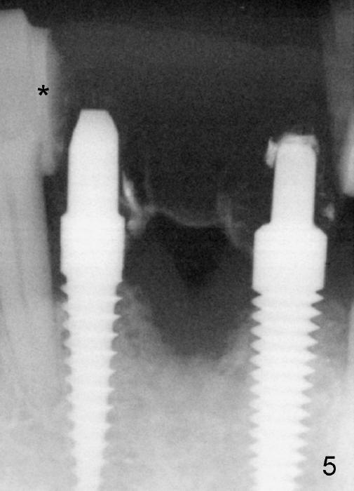 Immediate Implantsupported Bridge, Duluth, GA Dentist Dental Education